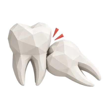 Ilustração 3D de dente siso inclinado pressionando o molar vizinho