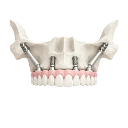 Ilustração 3D de maxila com implantes zigomáticos e prótese fixa